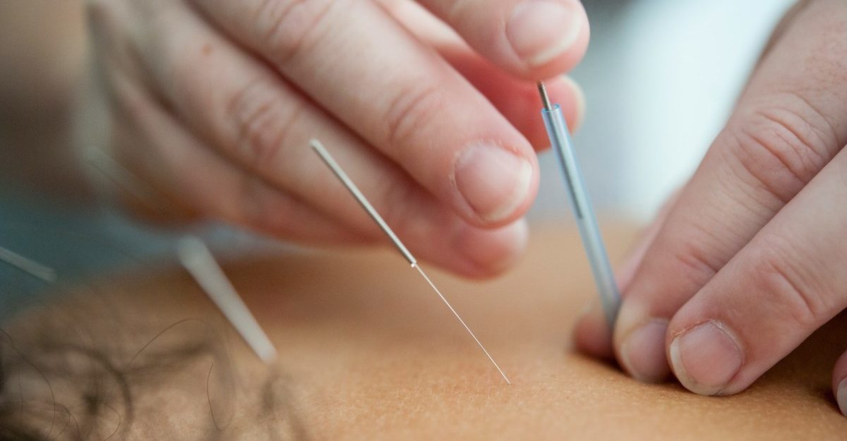 A close-up of an acupuncturist's hands inserting needles into a patient's back.