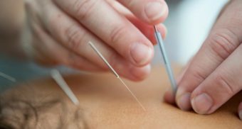 A close-up of an acupuncturist's hands inserting needles into a patient's back.